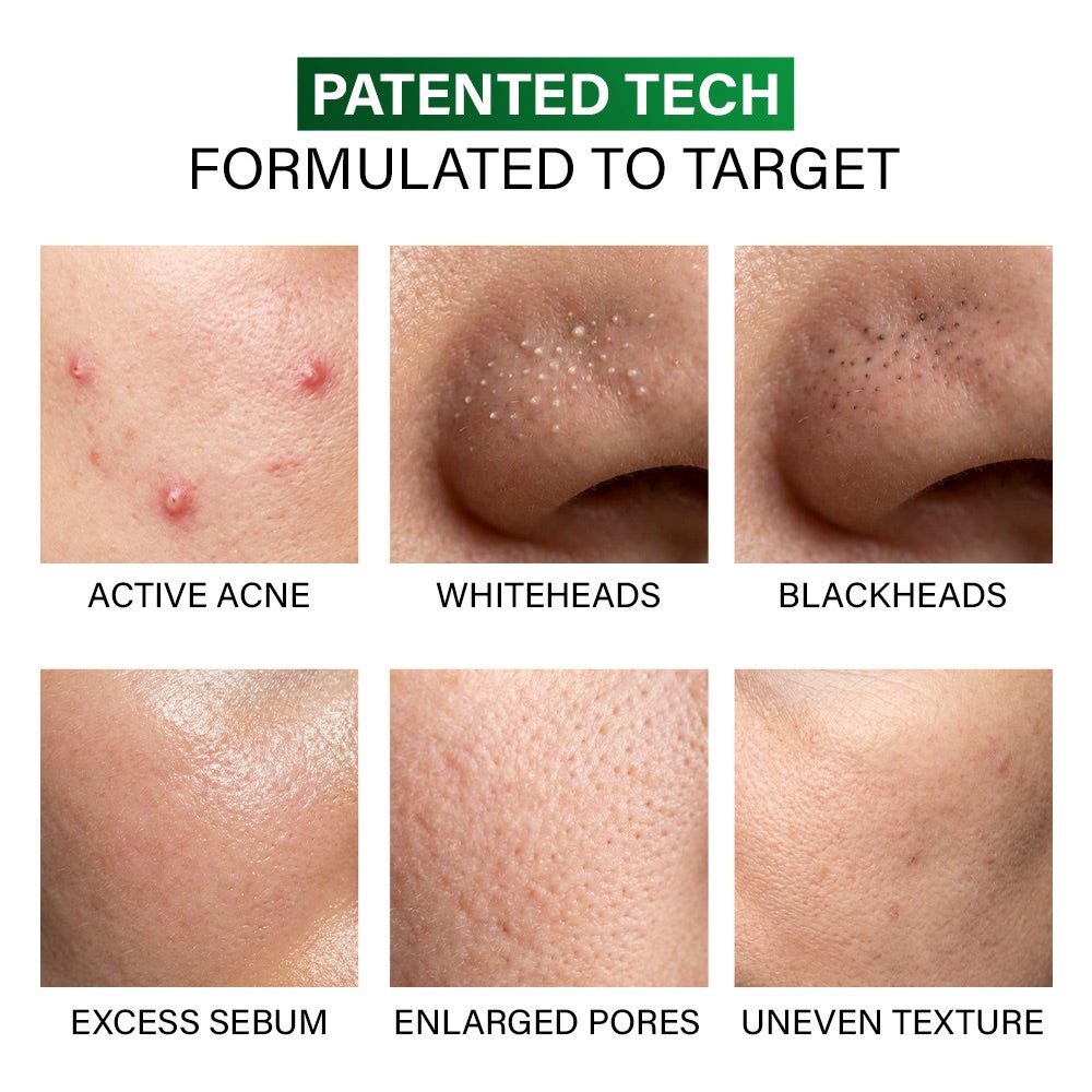 Acne Deep Clearing Cleanser