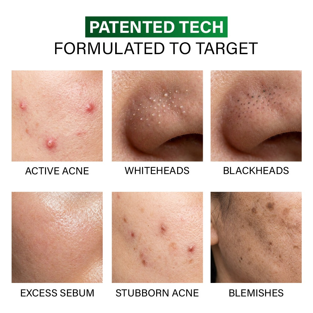 Acne Rescue Spot Corrector, 30g