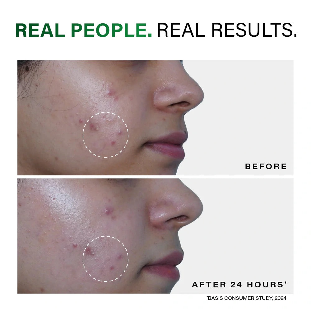 Acne Rescue Spot Corrector, 30g