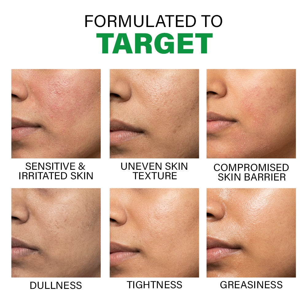Acne Light Moisturizing Gel, 50g