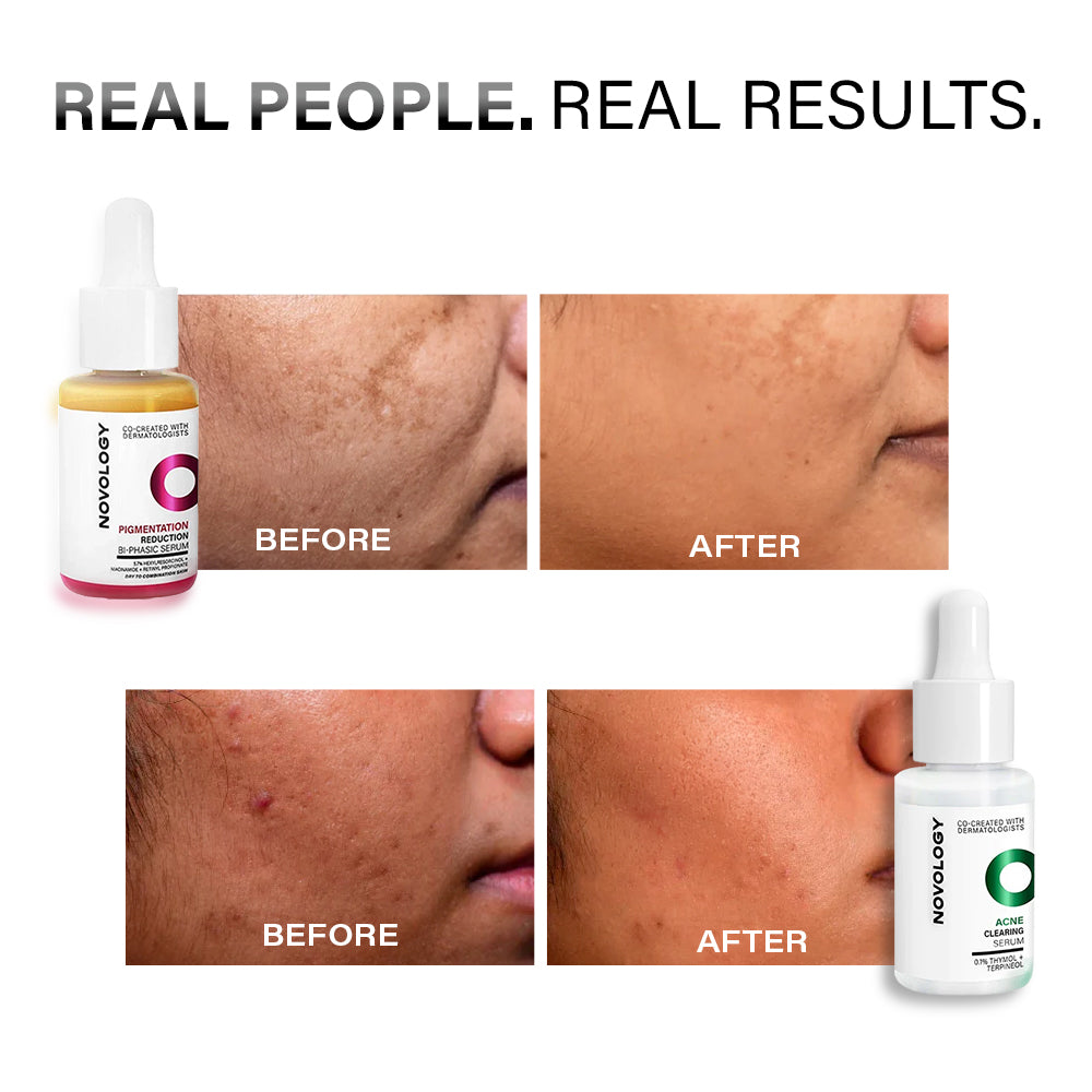 Acne & Pigmentation Serum Mini Duo
