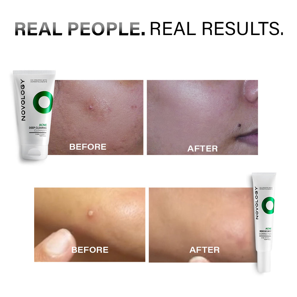 Acne Cleanser & Spot Corrector Duo | 150g + 30g