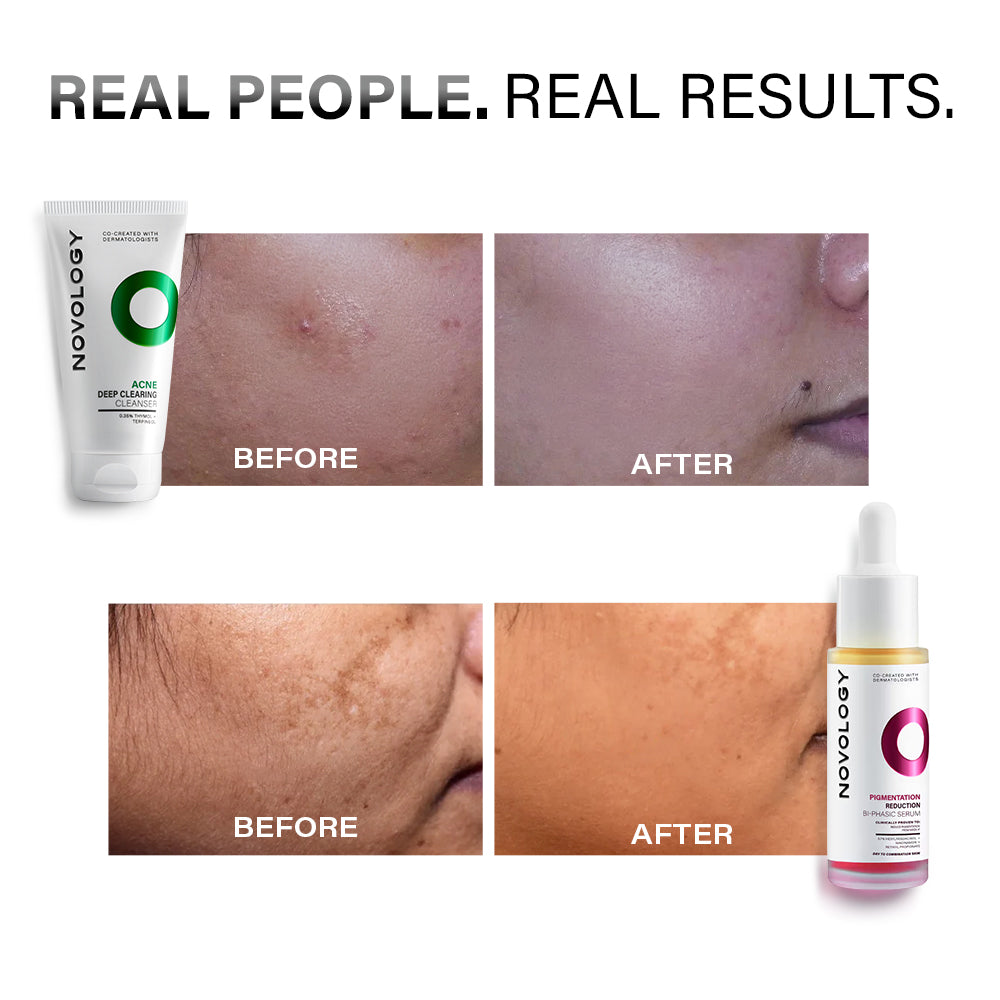 Acne Cleanser & Pigmentation Serum Duo