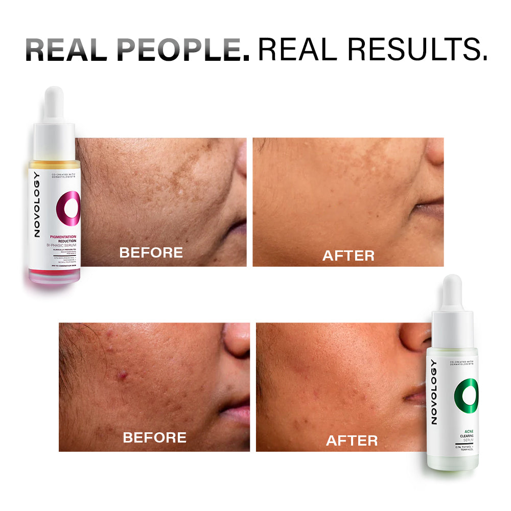 Acne Serum & Pigmentation Serum Duo | 28ml + 28ml