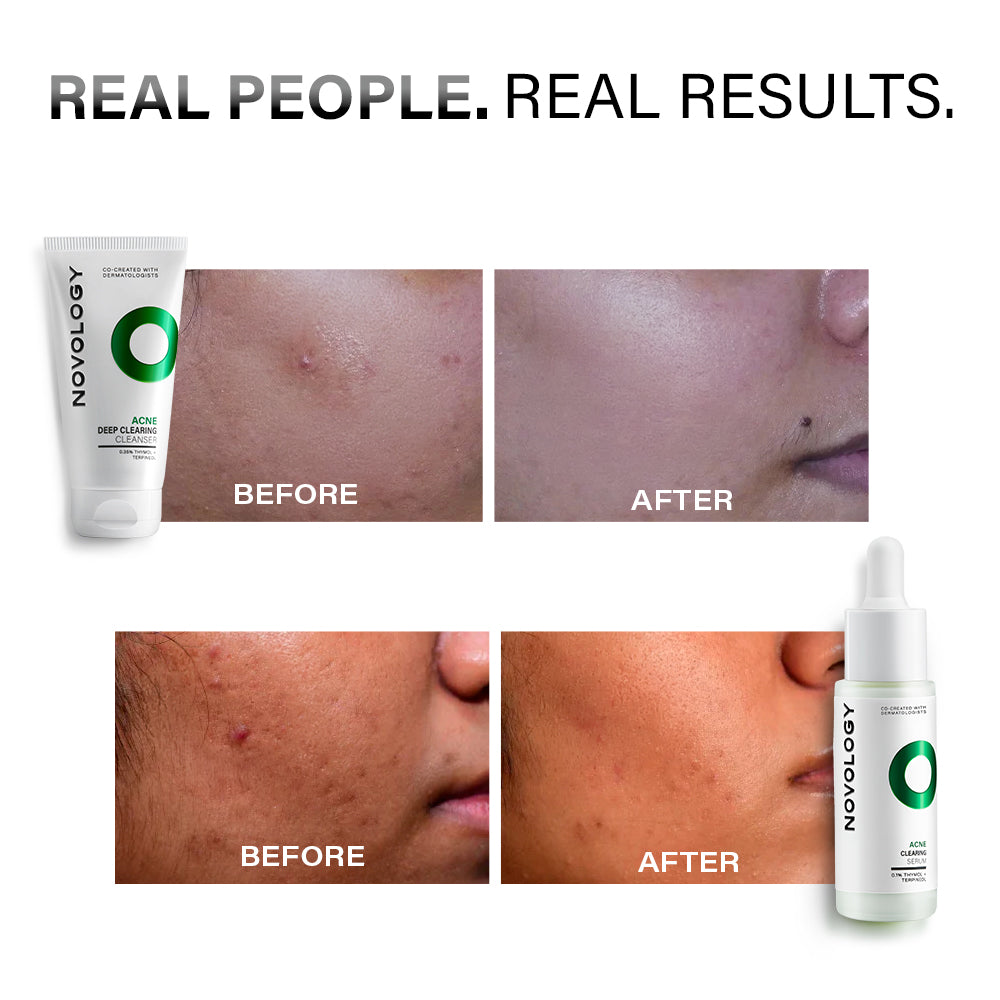 Acne Cleanser & Serum Duo | 100g + 28ml