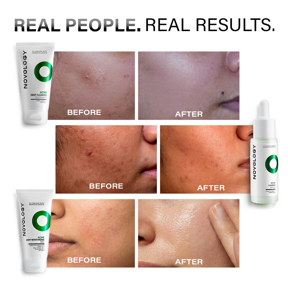 Acne Clearing Regime | 150g + 28ml + 50g