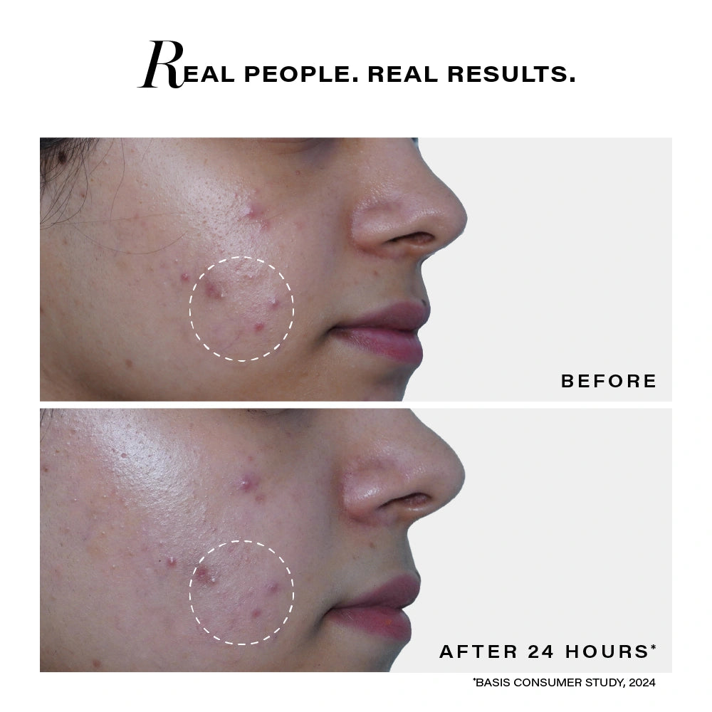 Acne Rescue Spot Corrector, 30g
