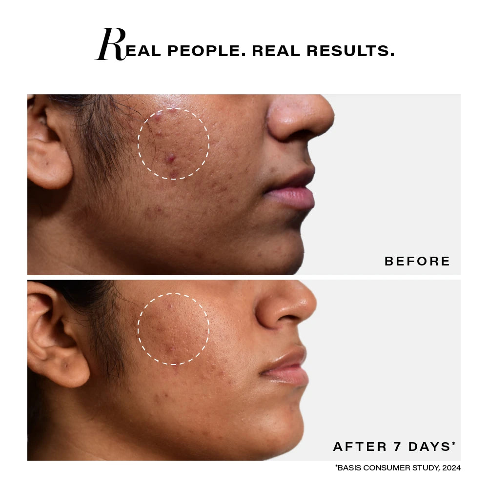 Acne Clearing Serum, 28ml